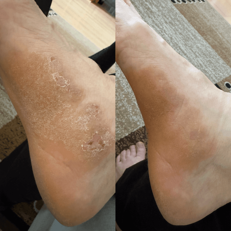 Crema CBD per pelle secca, atopica ed eczematosa