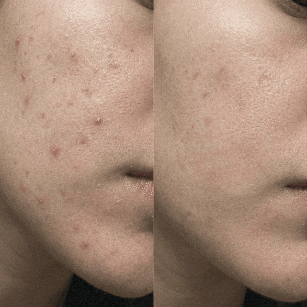 Crema CBD Purificante Anti-imperfezioni per pelli a tendenza acneica