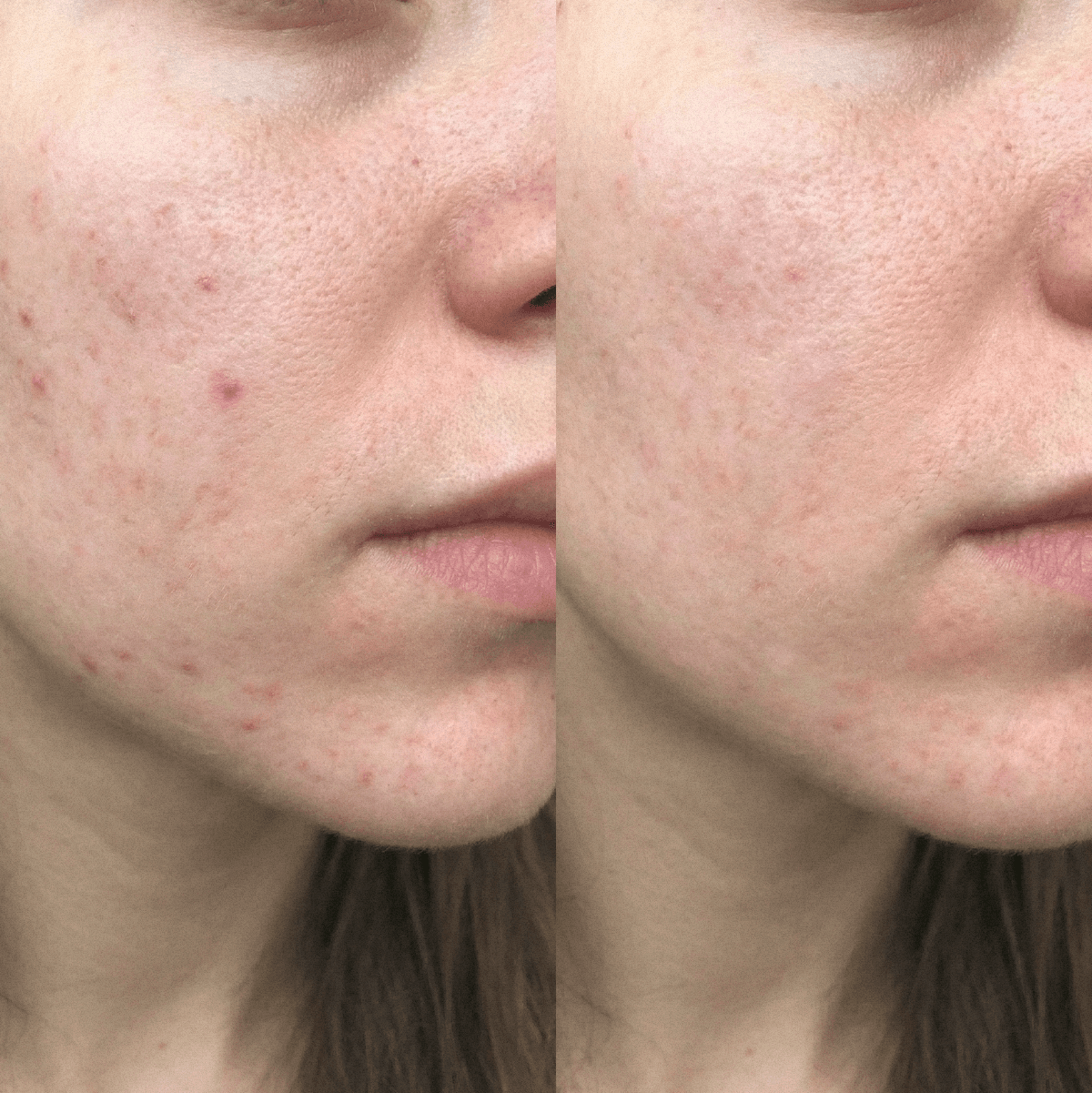 Crema CBD Purificante Anti-imperfezioni per pelli a tendenza acneica