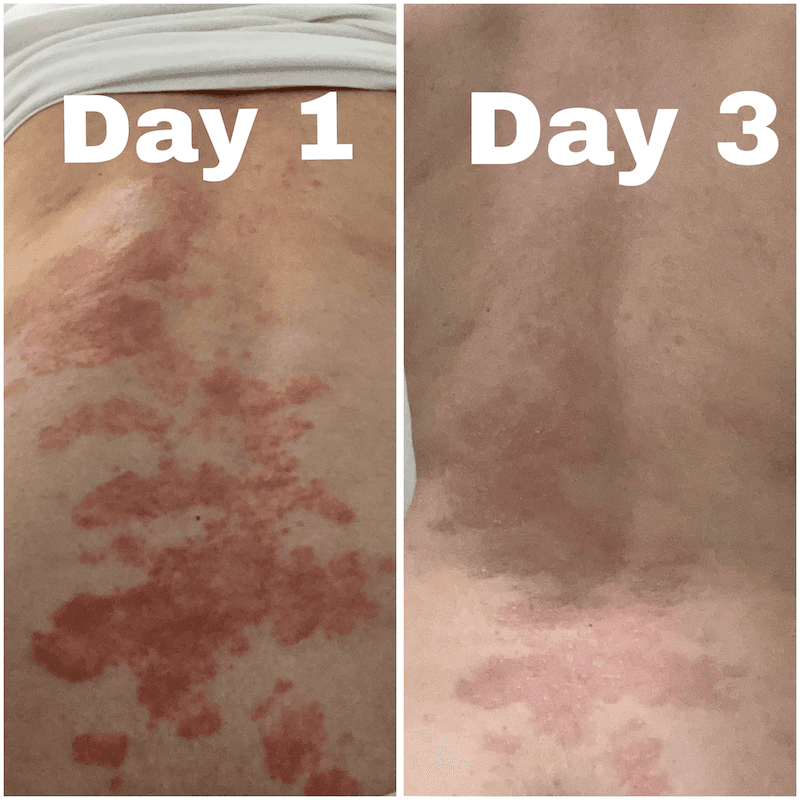 Crema CBD per pelle secca, atopica ed eczematosa