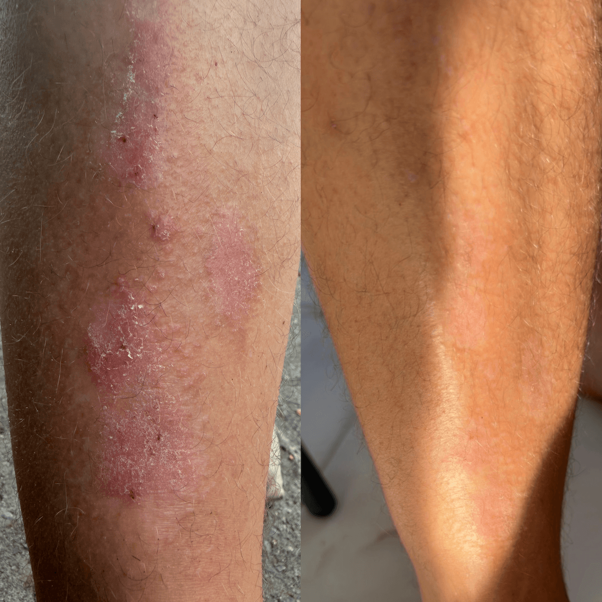Crema CBD Riparatrice per pelle secca, desquamata e a tendenza psoriasica